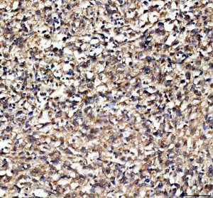 EPB41L5 Antibody Human Melanoma IHC. Immunohistochemical staining of FFPE human melanoma tissue using EPB41L5 antibody demonstrated predominantly membranous and cytoplasmic staining in tumor cells, consistent with the role of EPB41L5 in epithelial-mesenchymal transition, cell adhesion remodeling, and cell migration. Heat-induced epitope retrieval was performed in pH 8.0 EDTA buffer prior to staining. Tissue sections were blocked with 10% goat serum and incubated with the primary antibody (2 ug/ml) overnight at 4Â°C, followed by a peroxidase-conjugated goat anti-rabbit IgG secondary antibody. Immunoreactivity was visualized using an HRP Super Vision detection system with DAB as the chromogen. This EPB41L5 Antibody, also called an Epithelial-Mesenchymal Transition Protein Antibody, is useful for investigating epithelial-mesenchymal transition, cell adhesion remodeling, tumor invasion, and cancer metastasis.