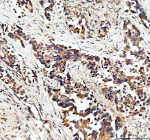 EPB41L5 Antibody Human Lung Cancer IHC. Immunohistochemical staining of FFPE human lung cancer tissue using EPB41L5 antibody demonstrated predominantly membranous and cytoplasmic staining in malignant cells, consistent with the role of EPB41L5 in epithelial-mesenchymal transition, cell adhesion remodeling, and tumor cell migration. Heat-induced epitope retrieval was performed in pH 8.0 EDTA buffer prior to staining. Tissue sections were blocked with 10% goat serum and incubated with the primary antibody (2 ug/ml) overnight at 4Â°C, followed by a peroxidase-conjugated goat anti-rabbit IgG secondary antibody. Immunoreactivity was visualized using an HRP Super Vision detection system with DAB as the chromogen. This EPB41L5 Antibody, also called an Epithelial-Mesenchymal Transition Protein Antibody, is useful for investigating epithelial-mesenchymal transition, cell adhesion remodeling, tumor invasion, and metastatic progression.