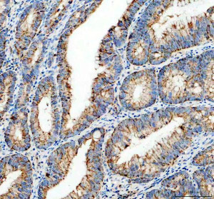 MRPS35 Antibody Human Colon Cancer IHC. Immunohistochemical staining of FFPE human colon cancer tissue shows MRPS35 expression following heat-induced epitope retrieval in pH8 EDTA buffer. Brown DAB staining is observed predominantly within the cytoplasm of tumor epithelial cells, consistent with the mitochondrial localization of mitochondrial ribosomal protein S35, while nuclei are counterstained blue with hematoxylin. The staining pattern supports expression of this mitochondrial translation factor in colorectal carcinoma tissue. This MRPS35 Antibody is suitable for studies of mitochondrial ribosomal protein S35, mitochondrial biology, and cancer-associated metabolic regulation.