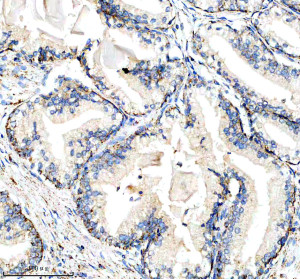 CYP17A1 Antibody in Human Prostate Cancer IHC. Immunohistochemistry staining of FFPE human prostate cancer tissue with CYP17A1 Antibody / Steroid 17-Alpha-Hydroxylase Antibody. Tissue sections underwent HIER in EDTA buffer, pH 8.0, and were blocked with 10% goat serum. The antibody was used at 1:50 overnight at 4oC, followed by a peroxidase-conjugated goat anti-rabbit IgG secondary antibody and DAB detection. The observed staining demonstrates CYP17A1 expression in human prostate cancer tissue.