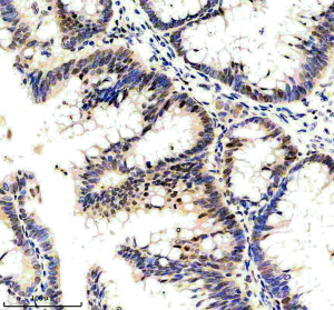 KIF4A Antibody 24K13 in Human Colon Cancer IHC. Immunohistochemistry staining of FFPE human colon cancer tissue with KIF4A Antibody 24K13 / Mitotic Kinesin Marker, clone 24K13, at 1:50 overnight at 4oC. HIER was performed using EDTA buffer, pH 8.0, followed by blocking with 10% goat serum. HRP/DAB detection demonstrates KIF4A staining in human colon cancer tissue.
