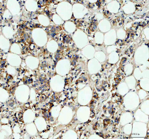 Carbonic Anhydrase XII Antibody by IHC in human breast cancer with membranous staining. Immunohistochemistry of FFPE human breast cancer tissue using Carbonic Anhydrase XII Antibody at 2 ug/ml. Brown immunoreactivity is distributed along the membranes and cytoplasm of numerous tumor-associated cells, with distinct cellular boundaries and relatively limited background staining. Hematoxylin counterstaining identifies blue-purple nuclei throughout the section. Heat-mediated antigen retrieval was performed in EDTA buffer at pH 8.0, followed by overnight primary antibody incubation at 4oC. This CA12 Polyclonal Antibody demonstrates membrane-associated immunoreactivity consistent with the localization of carbonic anhydrase XII.