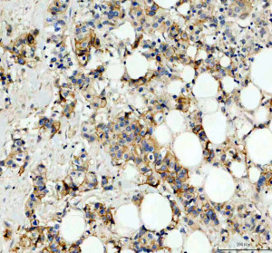 Carbonic Anhydrase XII Antibody by IHC in human breast cancer with heterogeneous tumor staining. Immunohistochemistry of FFPE human breast cancer tissue using Carbonic Anhydrase XII Antibody at 2 ug/ml. Moderate-to-strong brown immunoreactivity is observed in tumor-associated cells, with predominantly membranous and cytoplasmic staining. Signal intensity varies among neighboring cells, producing a heterogeneous distribution. Hematoxylin counterstaining highlights blue-purple nuclei. Heat-mediated antigen retrieval was performed using EDTA buffer at pH 8.0, followed by overnight incubation at 4oC. This CA12 Polyclonal Antibody demonstrates immunoreactivity within the cellular components of breast cancer tissue.