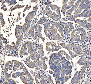 DLST Antibody by IHC in human colon cancer. Immunohistochemistry of FFPE human colon cancer tissue using DLST Antibody at 2 ug/ml. Brown DAB immunoreactivity is detected in the tissue section, with hematoxylin counterstaining highlighting cellular and glandular architecture. Heat-induced epitope retrieval was performed using EDTA buffer at pH 8.0, followed by overnight primary antibody incubation at 4oC. This Dihydrolipoamide Succinyltransferase Antibody detects the mitochondrial E2 component of the alpha-ketoglutarate dehydrogenase complex.