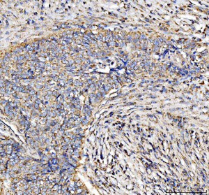 DLST Antibody by IHC in human lung cancer. Immunohistochemistry of FFPE human lung cancer tissue using DLST Antibody at 2 ug/ml. Brown DAB immunoreactivity is detected in the tissue section, demonstrating DLST expression. Hematoxylin counterstaining highlights nuclei and surrounding tissue architecture. Heat-induced epitope retrieval was performed using EDTA buffer at pH 8.0, followed by overnight primary antibody incubation at 4oC. This Dihydrolipoamide Succinyltransferase Antibody recognizes a mitochondrial enzyme involved in cellular energy metabolism.