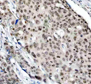 PPIG Antibody by IHC in Human Esophageal Carcinoma Tissue. Immunohistochemistry staining of FFPE human esophageal cancer tissue using rabbit polyclonal PPIG antibody at 2 ug/ml. Cyclophilin G immunoreactivity is observed in numerous tumor cell nuclei, with moderate to strong brown staining distributed throughout the malignant cell population. Nuclear labeling is accompanied by weaker cytoplasmic staining in some cells, while surrounding stromal elements exhibit comparatively limited immunoreactivity. Heat-induced antigen retrieval was performed using EDTA buffer (pH 8.0), followed by overnight primary antibody incubation at 4oC and DAB-based detection.