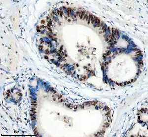 PPIG Antibody by IHC in Human Gastric Carcinoma Glands. Immunohistochemistry staining of FFPE human stomach cancer tissue using rabbit polyclonal PPIG antibody at 2 ug/ml. Cyclophilin G immunoreactivity is observed in malignant glandular epithelial cells, with prominent nuclear-associated brown staining and variable cytoplasmic labeling. The tumor glands show relatively strong staining compared with adjacent stromal elements, which exhibit limited immunoreactivity. Heat-induced antigen retrieval was performed using EDTA buffer (pH 8.0), followed by overnight primary antibody incubation at 4oC and DAB-based detection.