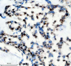 PPIG Antibody by IHC in Human Breast Carcinoma Tissue. Immunohistochemistry staining of FFPE human breast cancer tissue using rabbit polyclonal PPIG antibody at 2 ug/ml. Cyclophilin G expression is demonstrated by brown nuclear-associated staining in a subset of tumor cells, with variable intensity across the tissue section. Some cells exhibit additional diffuse cytoplasmic labeling, while others remain predominantly hematoxylin-positive. Heat-induced antigen retrieval was performed using EDTA buffer (pH 8.0), followed by overnight primary antibody incubation at 4oC and DAB-based detection.