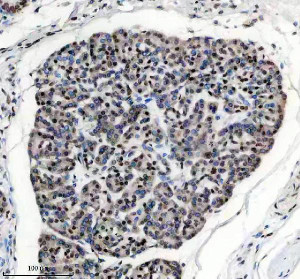 PPIG Antibody by IHC in Human Pancreatic Carcinoma Cell Clusters. Immunohistochemistry staining of a second FFPE human pancreatic cancer section using rabbit polyclonal PPIG antibody at 2 ug/ml. Cyclophilin G immunoreactivity is observed in densely arranged tumor cells, with moderate nuclear-associated staining and variable cytoplasmic labeling. The tumor cell clusters exhibit more extensive staining than the surrounding stromal regions. Heat-induced antigen retrieval was performed using EDTA buffer (pH 8.0), followed by overnight primary antibody incubation at 4oC and DAB-based detection.