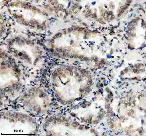 PPIG Antibody by IHC in Human Lung Carcinoma Tissue. Immunohistochemistry staining of FFPE human lung cancer tissue using rabbit polyclonal PPIG antibody at 2 ug/ml. Cyclophilin G immunoreactivity is observed in malignant epithelial cells, with brown nuclear-associated staining and variable cytoplasmic labeling. Tumor cells surrounding glandular structures show heterogeneous staining intensity, while intervening stromal cells are comparatively weakly labeled. Heat-induced antigen retrieval was performed using EDTA buffer (pH 8.0), followed by overnight primary antibody incubation at 4oC and DAB-based detection.