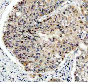 PPIG Antibody by IHC in Human Liver Carcinoma Tissue. Immunohistochemistry staining of FFPE human liver cancer tissue using rabbit polyclonal PPIG antibody at 2 ug/ml. Cyclophilin G expression is demonstrated by heterogeneous brown staining in tumor cells, involving both nuclear and cytoplasmic compartments. Some cells show relatively strong nuclear-associated labeling, while others exhibit weaker diffuse staining. Heat-induced antigen retrieval was performed using EDTA buffer (pH 8.0), followed by overnight primary antibody incubation at 4oC and DAB-based detection.