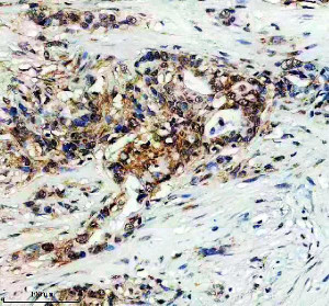 DNAAF4 Antibody by IHC in Human Pancreatic Cancer Tissue. Immunohistochemistry analysis of DNAAF4 in a paraffin-embedded human pancreatic cancer section using DNAAF4 Antibody. Brown DAB immunoreactivity is visible in groups of tumor cells, with variable intensity across the field. Blue hematoxylin counterstaining outlines nuclei and highlights the surrounding fibrous stroma, which exhibits comparatively little brown labeling. Antigen retrieval was performed in EDTA buffer at pH 8.0, followed by 10% goat serum blocking and incubation with 2 ug/ml primary antibody overnight at 4oC. A peroxidase-conjugated secondary antibody and DAB chromogen were used for visualization. The Dynein axonemal assembly factor 4 Antibody detects staining in this tissue.