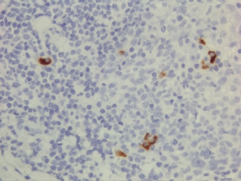 Human IgG3 Antibody Immunohistochemistry Human Lymphoid Tissue. Immunohistochemistry analysis of FFPE human lymphoid tissue using Human IgG3 Antibody / Anti-Human IgG3 Detection Antibody (clone RM119) demonstrates scattered cytoplasmic staining in lymphoid cells consistent with immunoglobulin-producing cell populations, while surrounding cells remain largely negative. This staining pattern reflects detection of IgG3 / IGHG3 within antibody-secreting cells and supports the use of this antibody for identifying IgG3-expressing cell populations in tissue sections. Heat-induced epitope retrieval was performed using either pH6 citrate buffer or pH9 Tris-EDTA buffer prior to antibody incubation.