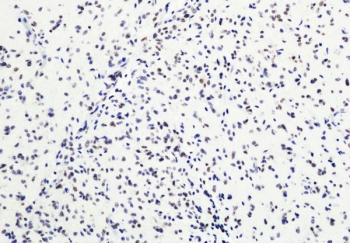 IHC staining of FFPE human glioblastoma tissue with recombinant H3K27me3 antibody. HIER: boil tissue sections in pH6, 10mM citrate buffer, for 20 min and allow to cool before testing.