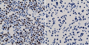 His Tag Antibody Human 293T Cell ICC. Immunocytochemistry was performed using recombinant His Tag Antibody clone RM146 on human HEK293T cells expressing a His-tagged nuclear protein (left) and negative control HepG2 cells lacking the tagged protein (right). Bound antibody was visualized with an HRP-conjugated secondary antibody and DAB chromogen, followed by hematoxylin counterstaining. Strong nuclear staining is observed in the HEK293T cells expressing the His-tag fusion protein, while the negative control cells show no detectable staining. These results demonstrate that this Polyhistidine Tag Antibody specifically detects His-tagged recombinant proteins in immunocytochemistry applications with minimal background.