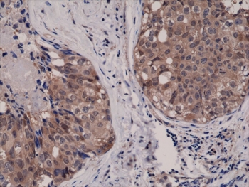 Recombinant AKT1 Antibody Breast Cancer IHC. Immunohistochemistry testing of FFPE human breast cancer tissue with Recombinant AKT1 Antibody at 1:1000.