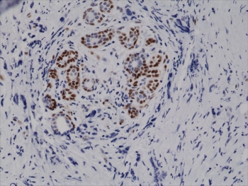Phospho-STAT3 Antibody Breast Cancer IHC. Immunohistochemistry analysis of FFPE human breast carcinoma tissue stained with phospho-STAT3 antibody detecting STAT3 phosphorylated at Tyr705, clone RM261. Tumor epithelial cells show strong nuclear HRP-DAB brown staining with accompanying cytoplasmic signal, consistent with activated STAT3 transcriptional signaling. Surrounding stromal cells display lower staining intensity, while nuclei are counterstained blue. HIER: heat-mediated antigen retrieval in EDTA buffer.