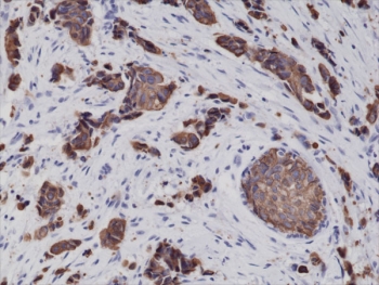 CK8 Antibody Breast Cancer IHC. Immunohistochemical staining of FFPE human breast cancer tissue using recombinant CK8 Antibody (clone RM266) at a 1:2000 dilution demonstrates strong cytoplasmic and membranous HRP-DAB brown staining within malignant epithelial cells. The staining pattern is consistent with expression of Cytokeratin 8 (CK8/KRT8), a type II intermediate filament protein widely expressed in simple epithelial tissues and epithelial-derived carcinomas. CK8 immunoreactivity highlights neoplastic epithelial cell populations and supports evaluation of epithelial differentiation and tumor-associated cytoskeletal organization in breast cancer specimens.