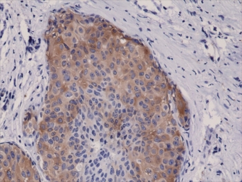 Phospho-ACC1 (Ser79) Antibody Breast Cancer IHC. Immunohistochemistry analysis of ACACA / Acetyl-CoA carboxylase 1 phosphorylation in FFPE human breast cancer tissue using Phospho-ACC1 (Ser79) Antibody - AMPK signaling marker (clone RM270) at 1:5000. Cytoplasmic HRP-DAB brown staining is observed in tumor epithelial cells, consistent with phosphorylated ACC1 localization and reflecting AMPK-mediated metabolic regulation within cancer cells, while nuclei are counterstained blue.