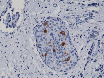 IHC testing of FFPE human breast cancer tissue with recombinant Cyclin B1 antibody at 1:2000.