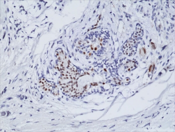 Estrogen Receptor alpha Antibody N-Terminal Region IHC. Immunohistochemistry staining of formalin fixed and paraffin embedded human breast cancer tissue using recombinant Estrogen Receptor alpha antibody at a 1:100 dilution. HIER: steam section in pH6 citrate buffer for 20 min and allow to cool prior to testing.