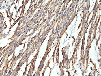 CD34 Antibody Gastrointestinal Stromal Tumor IHC. Immunohistochemistry testing of formalin fixed and paraffin embedded human gastrointestinal stromal tumor tissue with recombinant CD34 antibody at 1:400 dilution. HIER: steam section in pH6 citrate buffer for 20 min and allow to cool prior to staining.