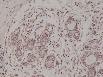 AKT Antibody Breast Cancer Tissue IHC. Immunohistochemistry of FFPE human breast carcinoma tissue using AKT antibody shows HRP-DAB brown cytoplasmic and nuclear staining in tumor epithelial cells, consistent with PI3K-dependent AKT signaling and membrane recruitment dynamics mediated by the PH domain, while surrounding stromal cells display lower background; detection was performed at 1:500 dilution using clone RM316. HIER: steam tissue sections in pH6 citrate buffer for 20 min and allow to cool prior to staining.