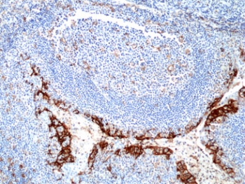 PD-L1 Antibody Tonsil Lymphoid Tissue IHC. Immunohistochemistry analysis of PD-L1 (CD274) expression in FFPE human tonsil using recombinant rabbit monoclonal clone RM320 at 1:250. Prominent staining is observed along stromal and immune cell-rich regions, outlining areas of active immune regulation within the lymphoid architecture. The distribution supports compartmentalized PD-L1 expression associated with immune cell interaction zones.