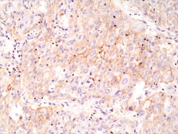 PD-L1 Antibody Lung Cancer IHC. Immunohistochemistry analysis of PD-L1 (CD274) expression in FFPE human lung cancer tissue using recombinant rabbit monoclonal clone RM320 at 1:1000. The antibody demonstrates membranous HRP-DAB brown staining in tumor epithelial cells with additional signal in scattered tumor-associated immune cells, consistent with immune checkpoint activity within the tumor microenvironment. The staining pattern shows heterogeneous expression across tumor regions, supporting evaluation of PD-L1 distribution and tumor-immune interactions.