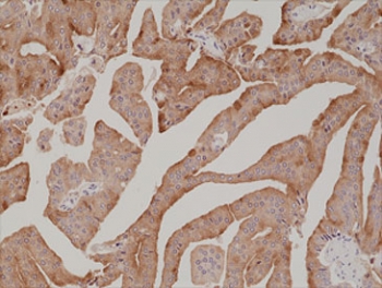 Prostate Specific Antigen Antibody Biotin Conjugate Prostate Cancer IHC. Immunohistochemistry staining of FFPE human prostate cancer tissue with recombinant Prostate Specific Antigen antibody at 1:1000.