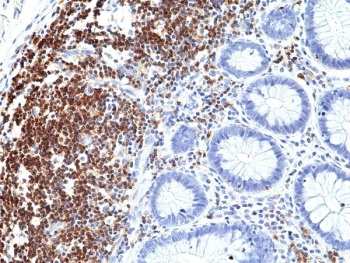 CD5 Antibody for IHC. Immunohistochemistry analysis of CD5 antibody staining in FFPE human colon tissue using an N-terminal directed antibody. Strong membranous staining is observed in infiltrating lymphocytes within the lamina propria and submucosal regions, while colonic epithelial cells remain largely negative. The staining highlights immune cell localization within gastrointestinal tissue and reflects recognition of the extracellular domain of CD5, supporting analysis of cell surface expression and lymphocyte distribution in non-lymphoid tissue.