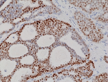 IHC staining of FFPE human breast cancer tissue with recombinant PR/Progesterone Receptor antibody at 1:100.