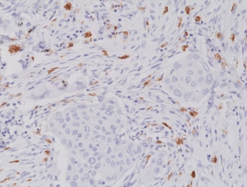 IHC staining of FFPE human lung cancer tissue with recombinant CD117 antibody at 1:2000.