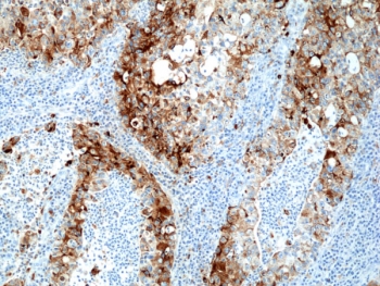 Napsin A Antibody for IHC. Immunohistochemistry analysis of Napsin A (NAPSA) expression in FFPE human lung adenocarcinoma tissue demonstrates strong cytoplasmic HRP-DAB brown staining in tumor epithelial cells with a granular intracellular pattern, while surrounding stromal cells remain largely negative. Clone RM366 highlights pulmonary epithelial differentiation consistent with the role of Napsin A as a lung adenocarcinoma marker, supporting its use in immunohistochemistry-based tumor characterization.