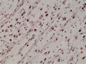 IHC staining of FFPE human Rhabdomyosarcoma tissue with recombinant Myogenin D1 antibody at 1:1000.