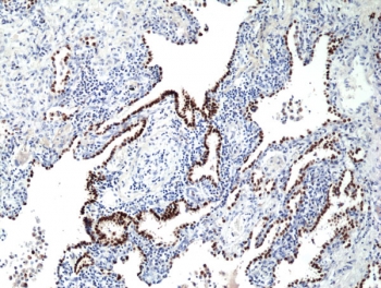 NKX2.1 Antibody Human Lung Cancer IHC. Immunohistochemical staining of FFPE human lung cancer tissue using NKX2.1 Antibody. NKX2.1 expression is observed predominantly within the nuclei of tumor cells, consistent with its established role as a lineage-specific transcription factor and marker of pulmonary epithelial differentiation. Strong nuclear immunoreactivity supports the utility of NKX2.1 for studies of lung development and pulmonary neoplasia.