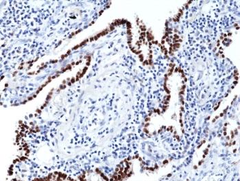 NKX2.1 Antibody Lung Cancer Tissue IHC. Immunohistochemical staining of FFPE human lung cancer tissue using NKX2.1 Antibody. Distinct nuclear staining is observed in neoplastic cells, consistent with the expression pattern of NKX2.1 in pulmonary epithelial-derived tumors. This result demonstrates the utility of NKX2.1 as a lineage-specific biomarker for lung cancer and supports its use in studies of pulmonary differentiation and tumor classification.