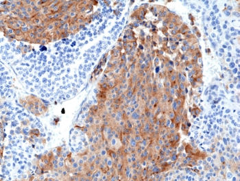 Chromogranin A Antibody Medullary Thyroid Carcinoma IHC. Immunohistochemistry staining of FFPE human medullary thyroid carcinoma tissue with recombinant Chromogranin A antibody at 1:2500.