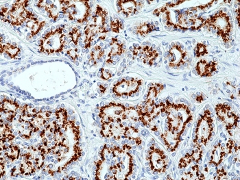Prostein Antibody for IHC. Immunohistochemistry analysis of Prostein / SLC45A3 antibody staining in FFPE human prostate cancer tissue. Strong cytoplasmic and perinuclear staining is observed in tumor epithelial cells forming irregular glandular structures, consistent with Golgi-associated localization of Prostein, while surrounding stromal components remain largely negative. The staining highlights androgen-responsive tumor epithelial populations and supports retention of SLC45A3 expression in prostate-derived carcinoma. The antibody was applied at a dilution of 1:100 following heat-induced epitope retrieval in pH 9 Tris-EDTA buffer for 20 minutes and cooling prior to incubation.