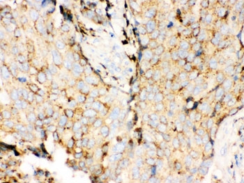 Cathepsin D Antibody Breast Cancer Immunohistochemistry. IHC testing of FFPE human breast cancer tissue with Cathepsin D antibody. HIER: steamed with pH6 citrate buffer, HRP-staining.
