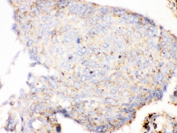 Cathepsin D Antibody Lung Cancer Immunohistochemistry. IHC testing of FFPE human lung cancer tissue with Cathepsin D antibody. HIER: steamed with pH6 citrate buffer, HRP-staining.