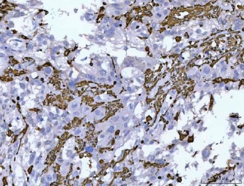 IHC staining of FFPE human invasive urothelial carcinoma tissue with Vimentin antibody. HIER: boil tissue sections in pH8 EDTA for 20 min and allow to cool before testing.