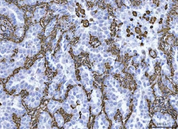 IHC staining of FFPE human lung adenocarcinoma tissue with Vimentin Antibody Clone V9. HIER: boil tissue sections in pH8 EDTA for 20 min and allow to cool before testing.