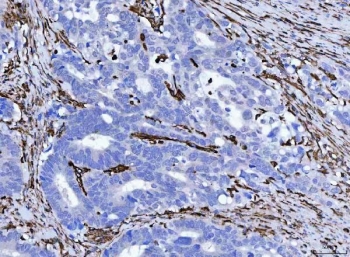 IHC staining of FFPE human colorectal adenocarcinoma tissue with Vimentin antibody. HIER: boil tissue sections in pH8 EDTA for 20 min and allow to cool before testing.