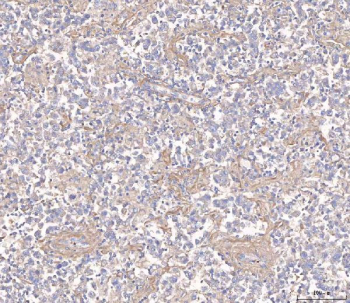Immunohistochemical staining of FFPE human testis cancer tissue with ANG2 antibody, HRP-secondary and DAB substrate. HIER: boil tissue sections in pH8 EDTA for 20 min and allow to cool before testing.