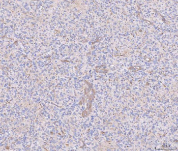 Immunohistochemical staining of FFPE human glioma tissue with ANG2 antibody, HRP-secondary and DAB substrate. HIER: boil tissue sections in pH8 EDTA for 20 min and allow to cool before testing.