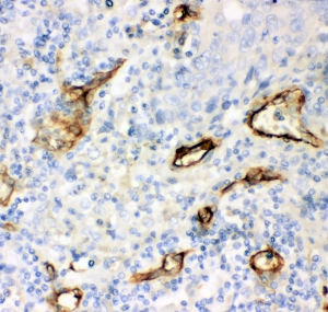IHC-P: CD146 antibody testing of human lung cancer tissue