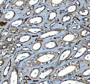 Immunohistochemical staining of FFPE human prostate cancer tissue with PKC delta antibody, HRP-secondary and DAB substrate. HIER: boil tissue sections in pH8 EDTA for 20 min and allow to cool before testing.