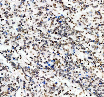 IHC staining of FFPE human breast cancer tissue with Lamin B1 antibody. HIER: boil tissue sections in pH8 EDTA for 20 min and allow to cool before testing.