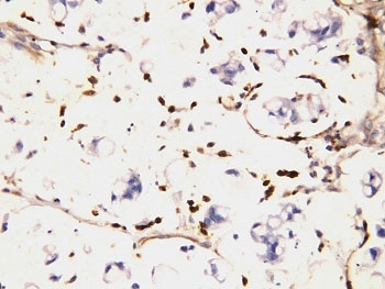 IHC-P: IFITM1 antibody testing of human intestinal cancer tissue